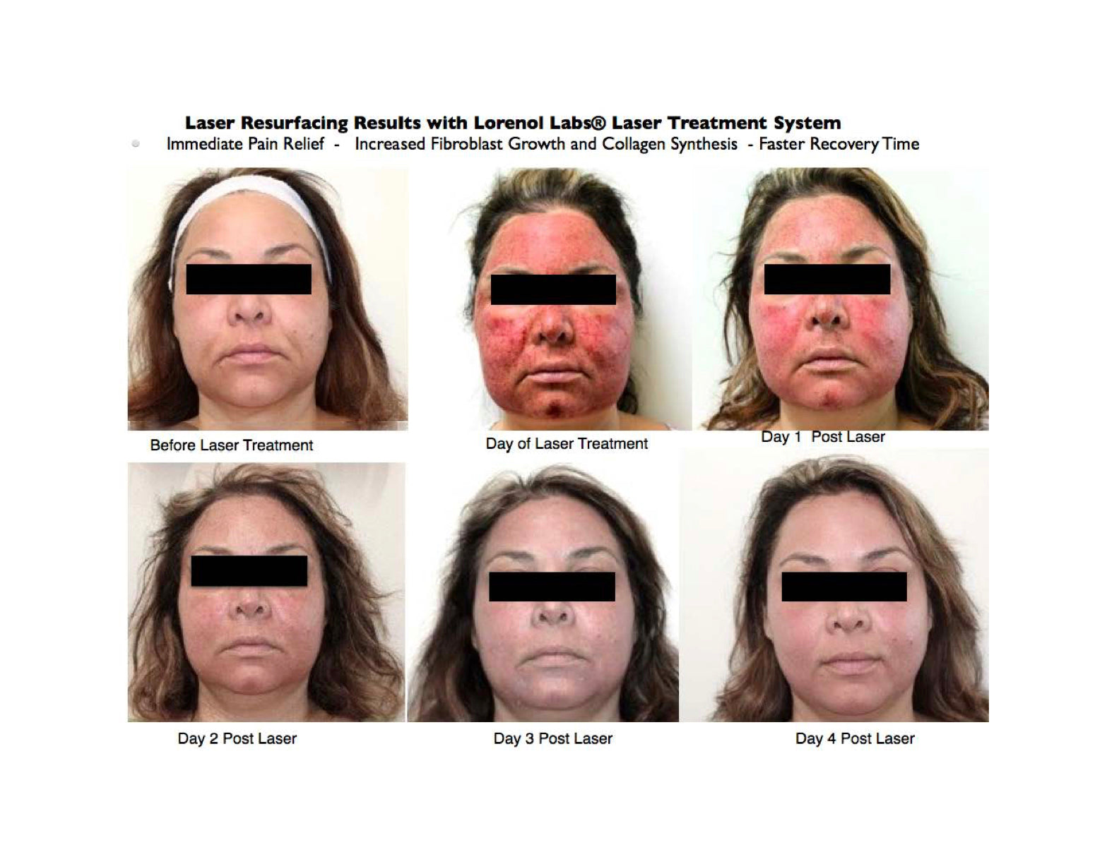 Laser Recovery System image 2