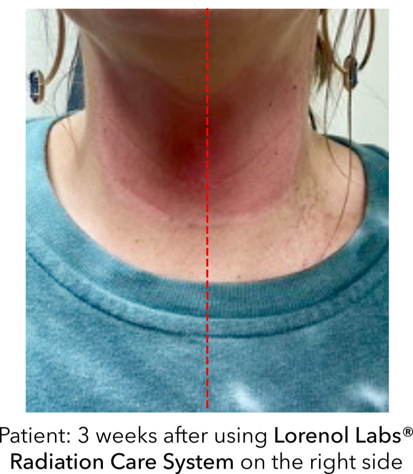 Radiation Care System image 2