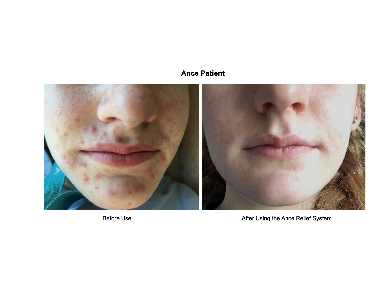 Acne Relief System image 2