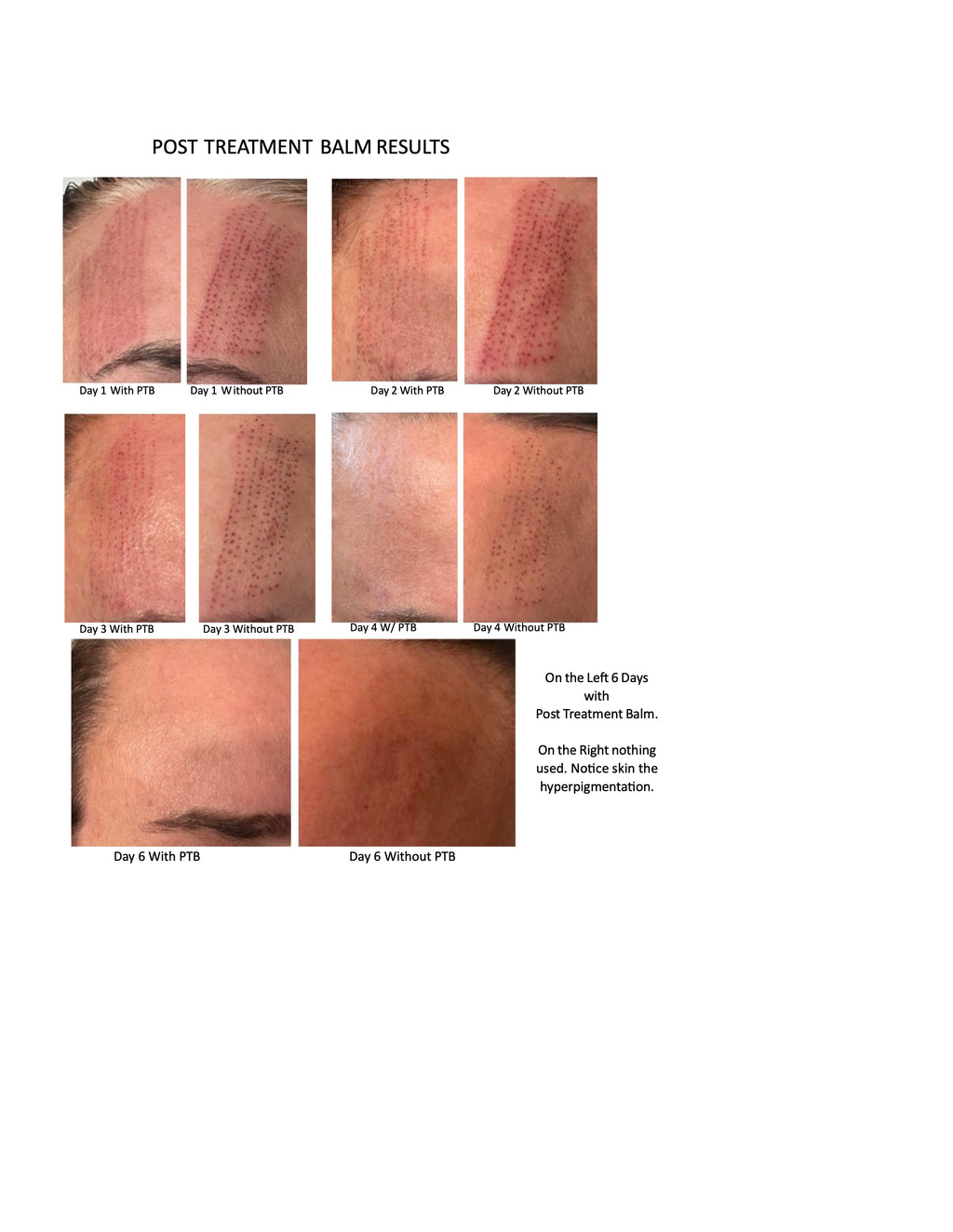 Laser Recovery System