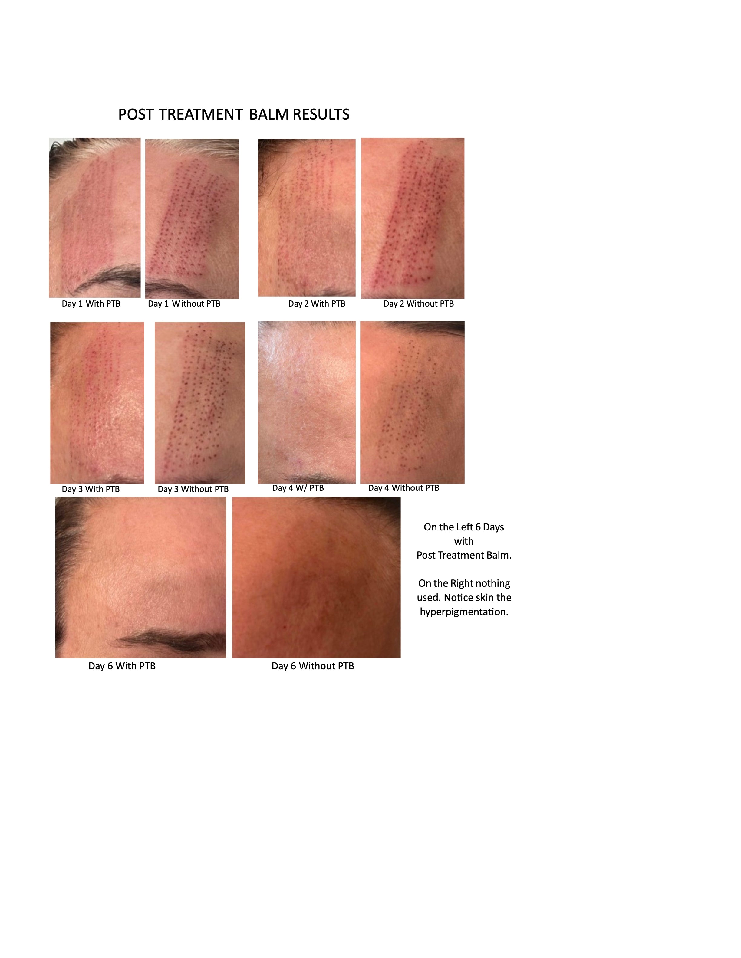 Laser Recovery System