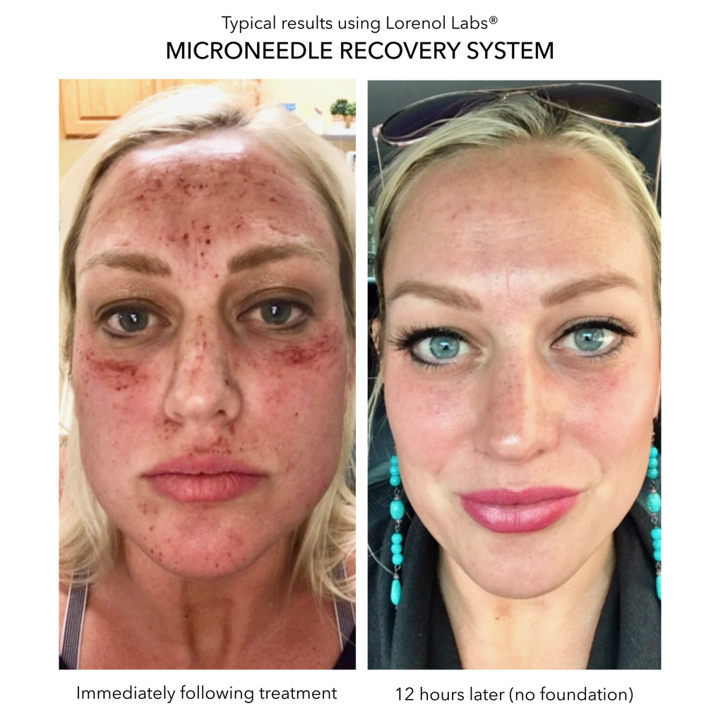Microneedlng Recovery System image 2