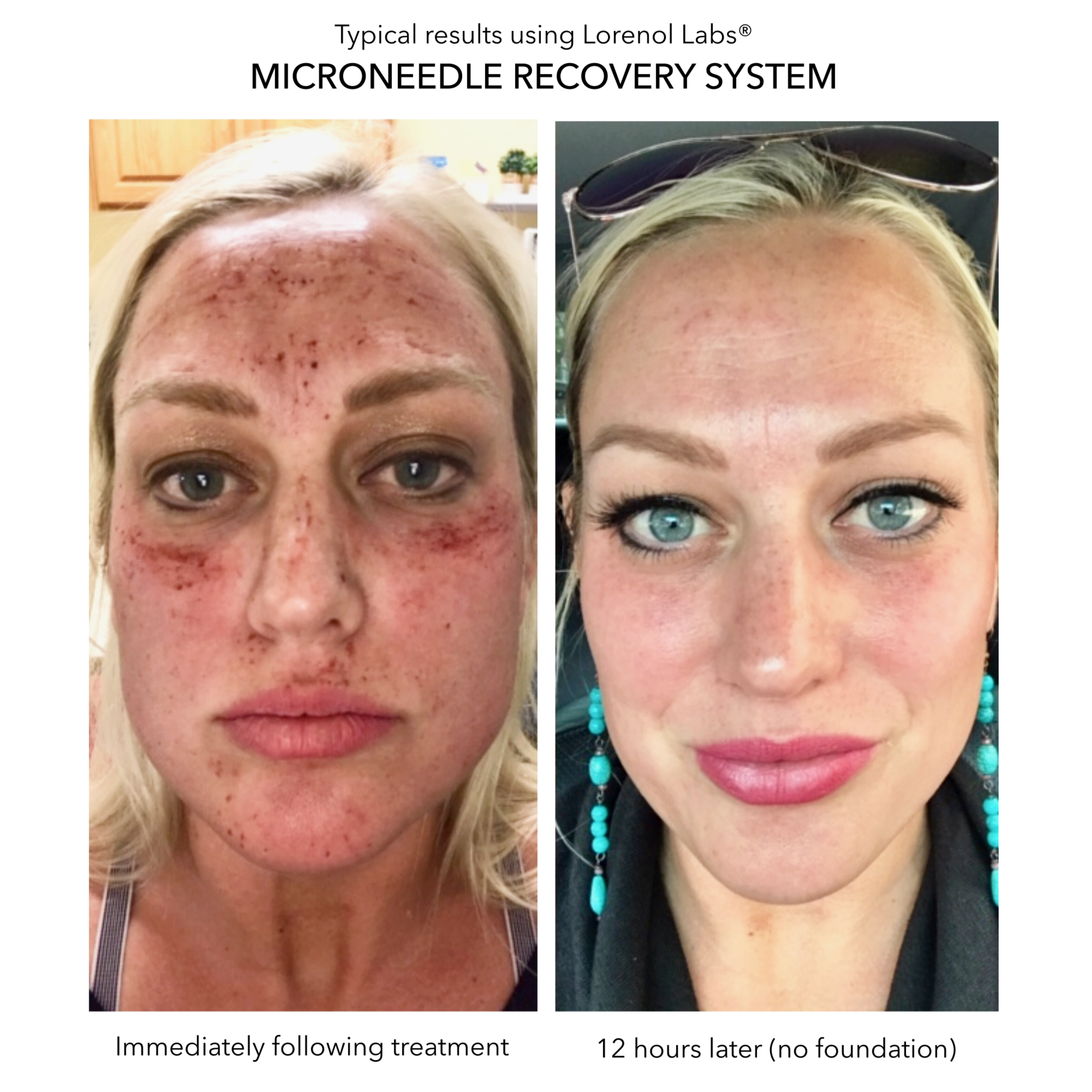 Microneedlng Recovery System image 2