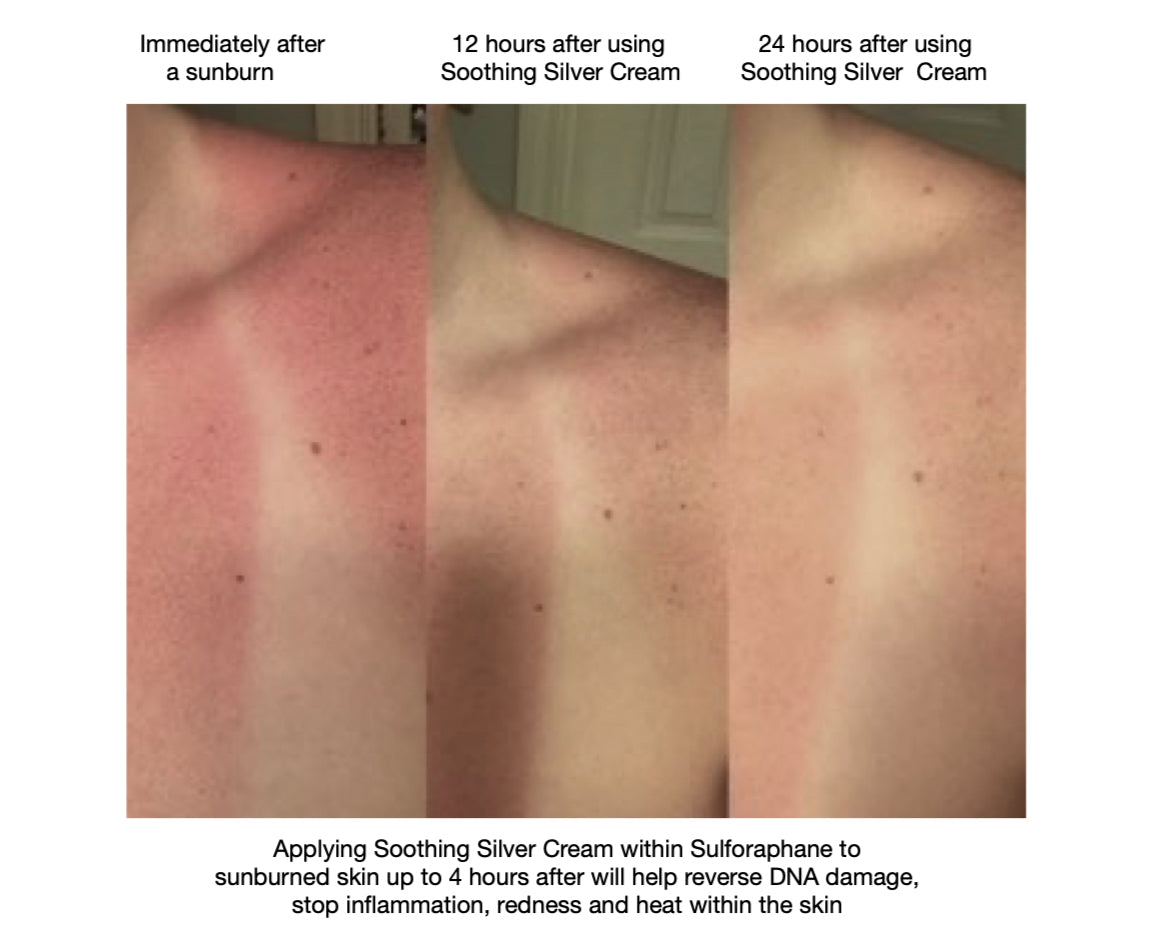 Emergency Sunburn Relief image 2