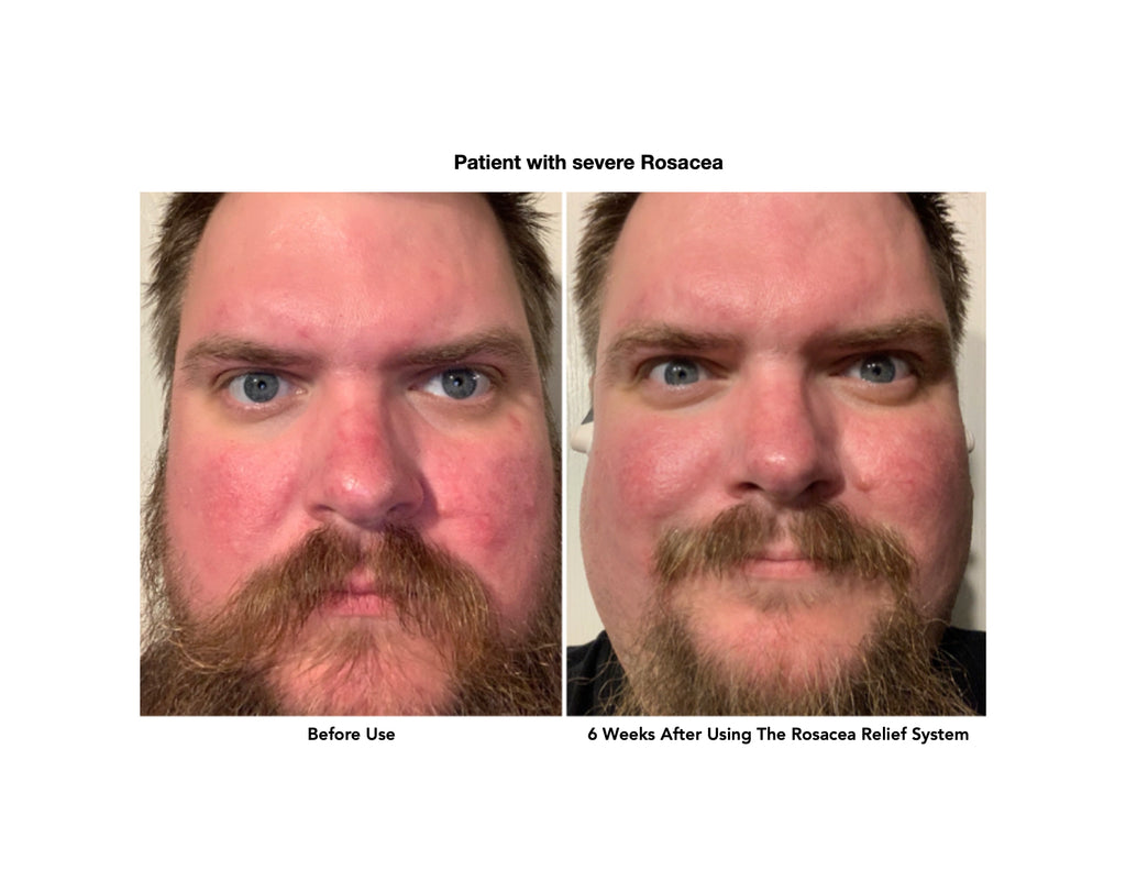 Rosacea Relief System image 2